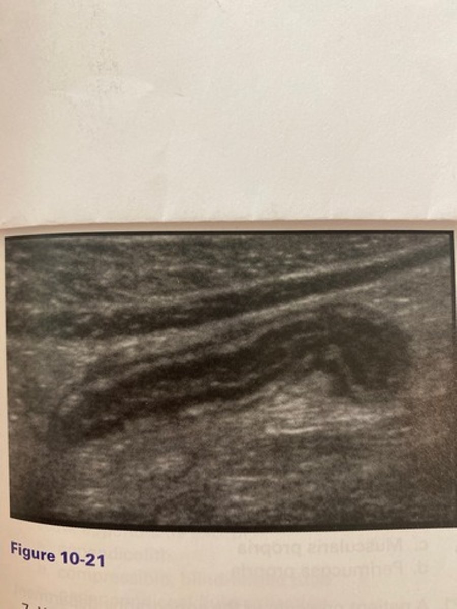 <p>Which of the following would be another common clinical finding for the patient in Figure 10-21?</p><p>a. Thyroid in the belly sign</p><p>b. Leukocytosis</p><p>c. Kernicterus</p><p>d. Hypernatremia</p>