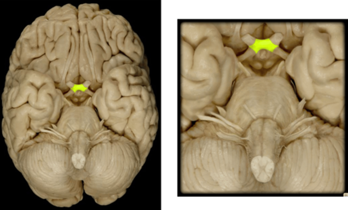 <p>The point at which nerve fibers from the medial side of each eyeball cross and go to the opposite side of the brain.</p>