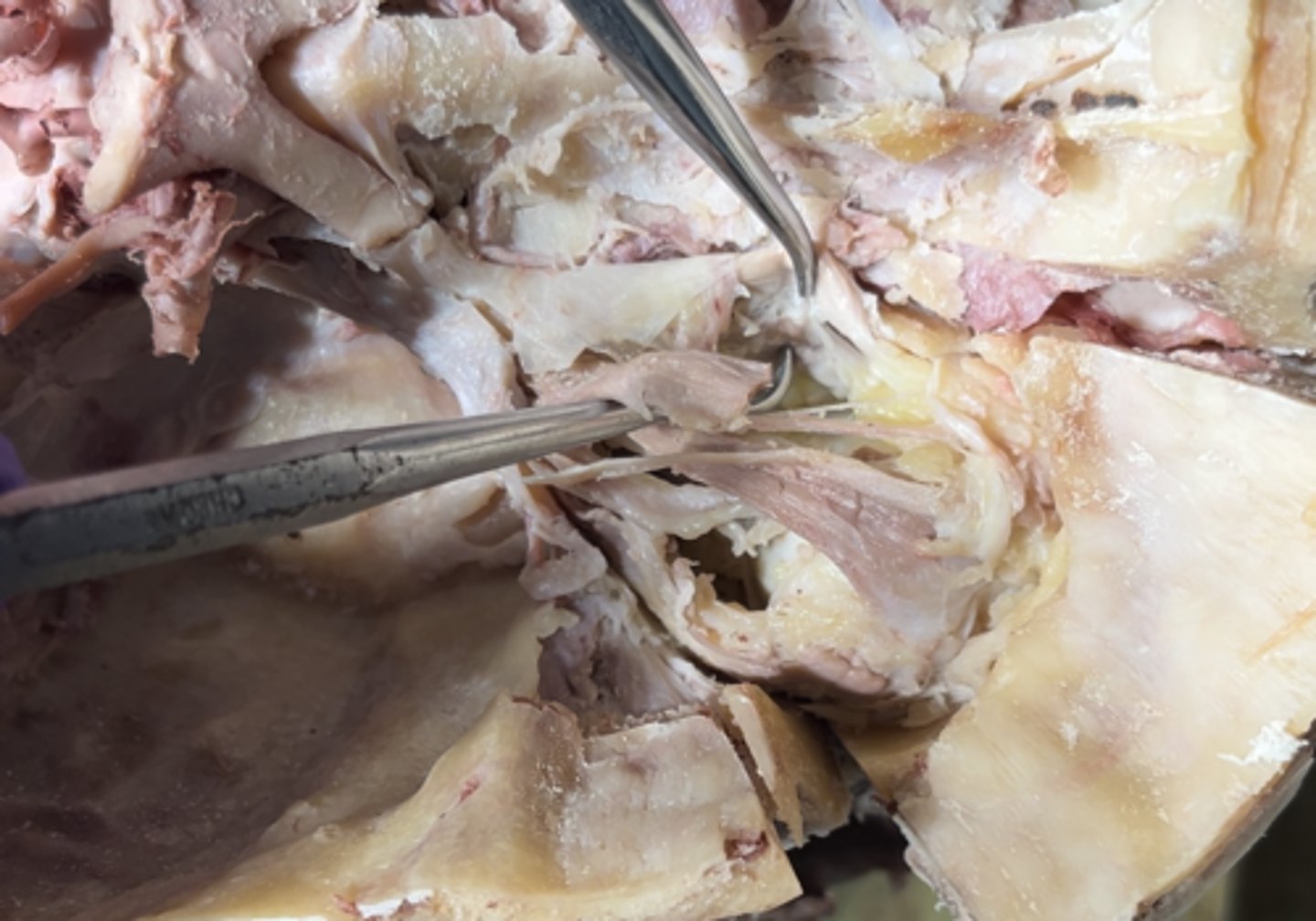 <p>Underneath the superior oblique muscle on the medial of the eye is going to be the</p>