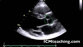 To the left of the aortic root.