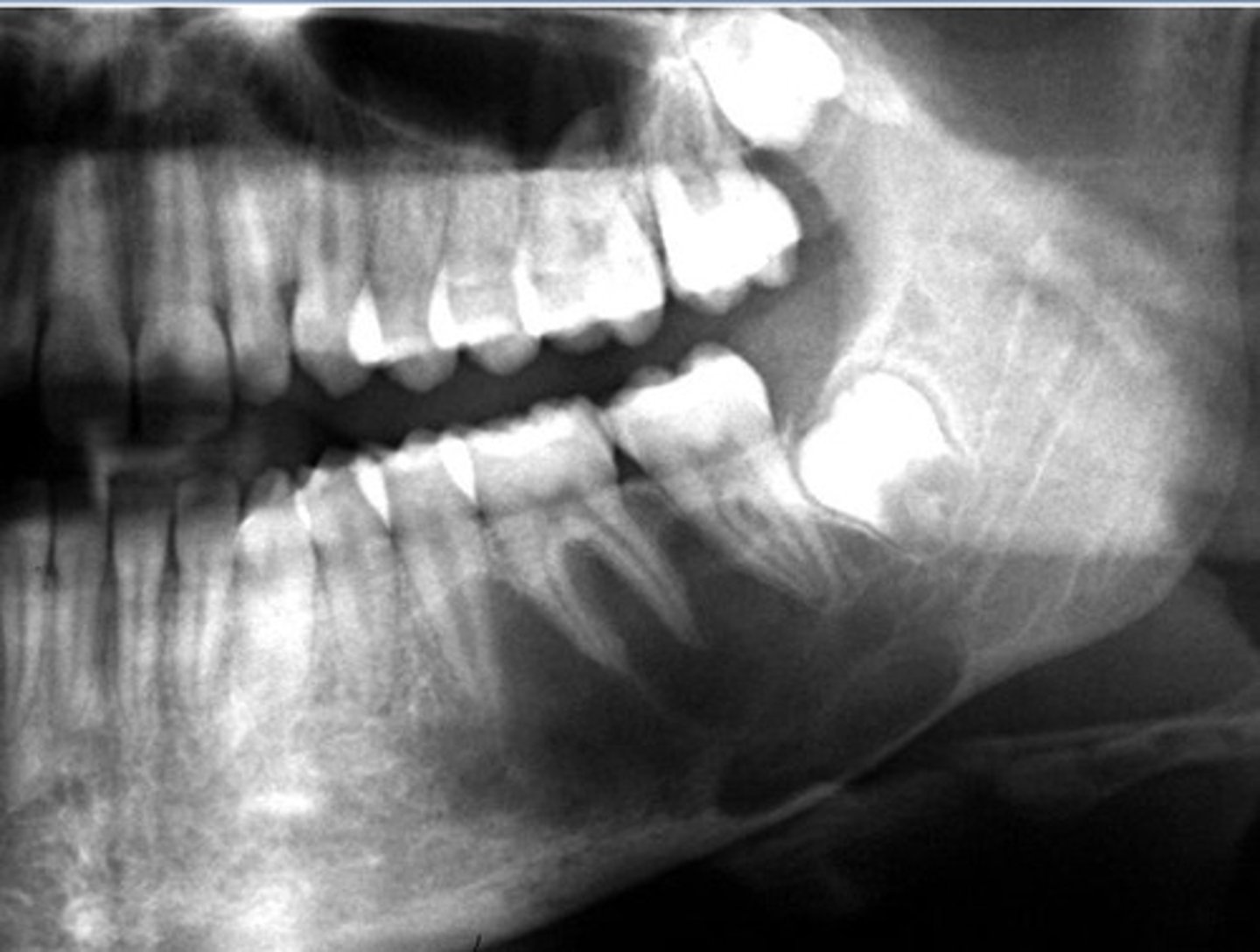 <p>what is your diagnosis?</p><p>- Unilocular radiolucency</p><p>- Scalloping between roots of vital teeth</p><p>- No root resorption</p><p>- Empty cavity</p>