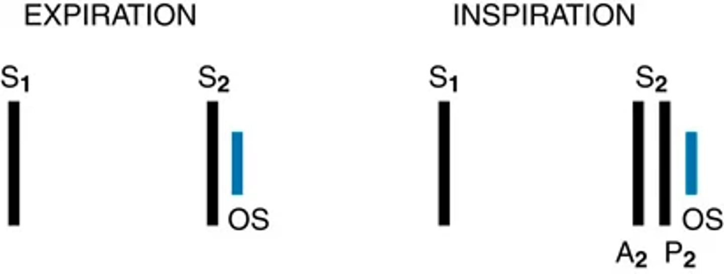 <p>Early diastole:Opening snap</p><p>Mitral prosthetic valve sound</p><p>Mid-diastole:Third heart sound</p><p>Summation sound (S3 + S4)</p><p>Late diastole:Fourth heart sound</p><p>Pacemaker-induced sound</p>