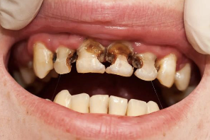 <p>What is the caries process?</p>