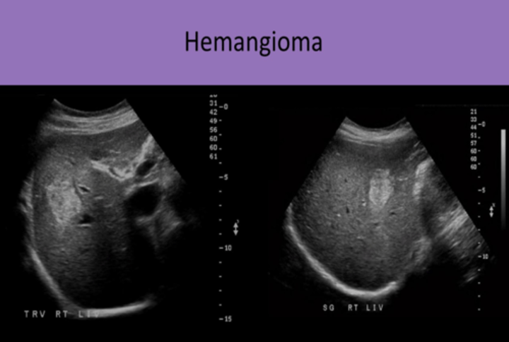 <p>1. #1 benign liver lesion<br>2. associated with FOCAL NODULAR HYPERPLASIA AND KASABACH-MERRITT SYNDROME<br>3. more common in FEMALES<br>4. usually found in RIGHT LOBE<br>5. usually SOLITARY, LESS THAN 3 CM<br>6. SUBCAPSULAR<br>7. most cases are ASYMPTOMATIC WITH NORMAL LFTs<br>8. can INCREASE SIZE with PREGNANCY and ESTROGEN THERAPY<br>9. differentiated from focal fatty replacement by the presence of MASS EFFECT</p>