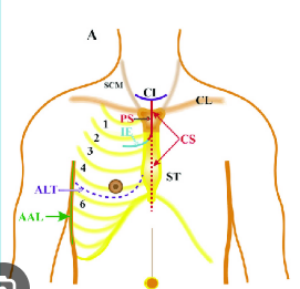 <ul><li><p class=""><strong>Incision:</strong> Along the <strong>anterior chest wall</strong></p><ul><li><p class="">(4th–6th intercostal space)</p></li><li><p class="">more toward the front</p></li></ul></li><li><p class=""><strong>Access:</strong> <strong>Heart, anterior lungs</strong>, chest wall</p></li><li><p class=""><strong>Used for:</strong></p><ul><li><p class="">Emergency thoracotomies (e.g., trauma)</p><ul><li><p class="">relieve the pressure- cardiac tamponade </p></li><li><p class="">clamp the blood vessel (aorta)- haemorrhage </p></li></ul></li><li><p class="">Some cardiac procedures</p></li></ul></li></ul><p></p>