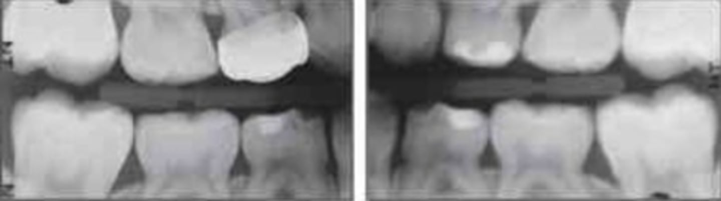 <p>what is the approximate age of this patient?</p><p>a. 5-6</p><p>b. 7-8</p><p>c. 9-10</p><p>d. 11-12</p>