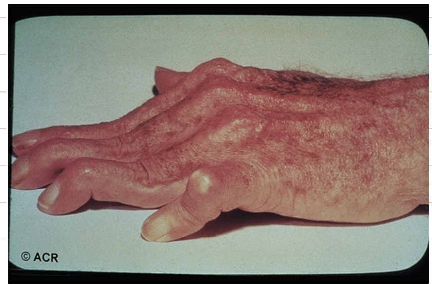 <p><mark data-color="#ffb6e8" style="background-color: #ffb6e8; color: inherit">RA causes different deformities of the joint. Explain what is seen in the following image.</mark></p><img src="https://knowt-user-attachments.s3.amazonaws.com/92a82ea6-6805-4edf-9f7c-643464ac39c8.png" data-width="100%" data-align="center" alt="knowt flashcard image"><p></p>