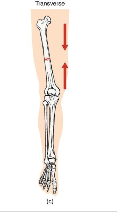 <p><strong>Definition: Straight horizontal break</strong> across the bone shaft</p><p><strong>Mechanism</strong>: <strong>Perpendicular force t</strong>o long axis (ex: direct impact)</p><p><strong>Clinical note</strong>: Often stable if bone ends align well: heals predictably with immobilizaton.</p><p><strong>Key Concept: compression or bending directly across bone.</strong></p>