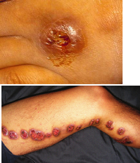 <ul><li><p class=""><strong>Cutaneous:</strong> A small, painless red or purple <strong>bump</strong> that becomes an <strong>ulcer with pus</strong>, slow to heal, and may form <strong>secondary sores</strong>.</p></li><li><p class=""><strong>Lymphangitic:</strong> Painless <strong>subcutaneous nodules</strong> forming a <strong>linear chain</strong> along the lymphatic vessel draining the original site. Appears ~2 weeks after the first lesion.</p></li></ul><p></p><p><em>*Lymphocutaneous Sporotrichosis is the most common clinical form of </em><strong><em>Sporothrix schenckii</em></strong></p>