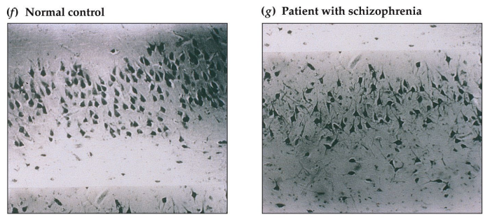 <p>Some schizophrenics have a deficiency of Reelin: A stop signal for migrating cells in hippocampus and prefrontal areas.</p>