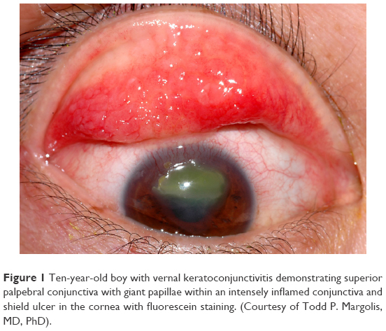 <ul><li><p>Reduced VA - corneal involvement</p></li><li><p>Thick, stringy mucous deposit may be seen&nbsp;</p></li><li><p><strong>Papillae on palpebral conjunctiva &gt;1mm in size</strong> - <span style="color: red"><strong>cobblestone </strong></span>c large hyperaemia -</p></li><li><p><strong>Superior punctate epithelial erosions</strong> - can become <strong>ulcerative </strong>in future - leads to <span style="color: blue"><strong>corneal ulcer</strong></span> - photophobia</p></li></ul><p></p>
