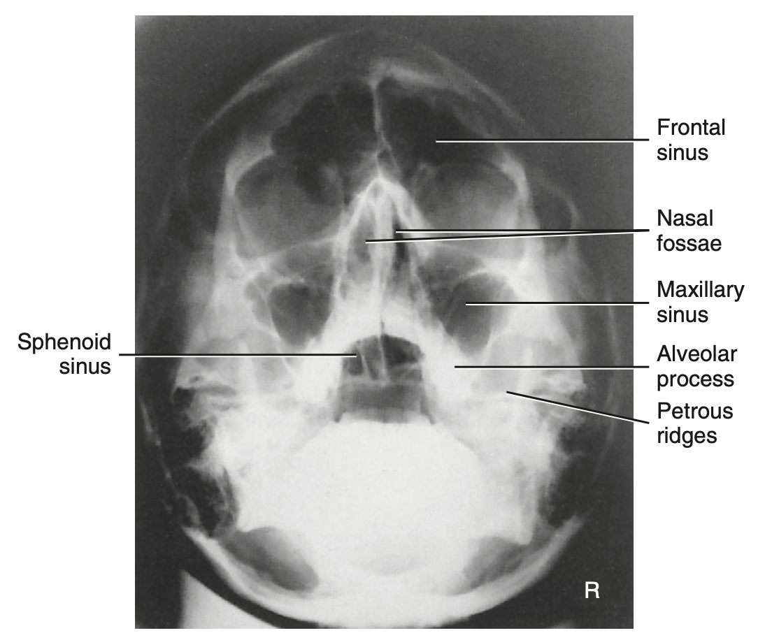 <p>Special: How do you <u>critique</u> radiograph of <strong>Parietocanthial transoral projection: Open mouth waters method </strong>for <strong>sinuses?</strong></p>