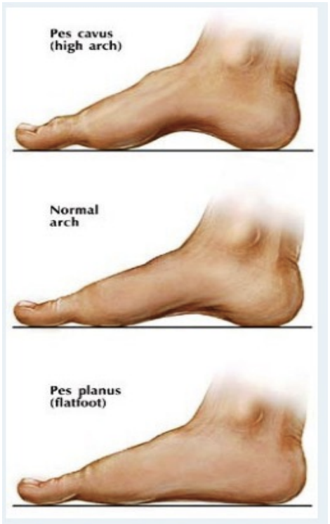 <p>Foot posture: Pes Cavus, Neutral &amp; Pes Planus</p>