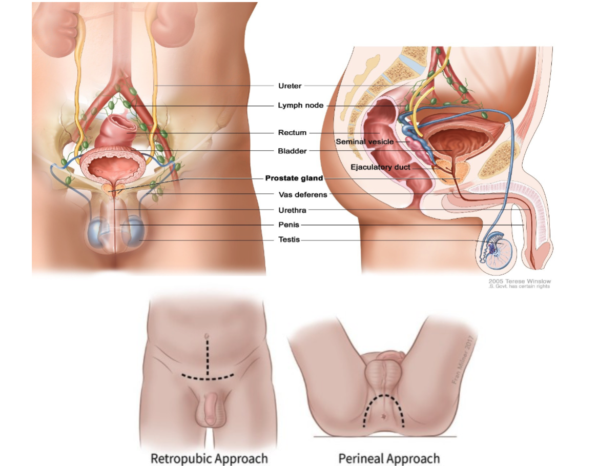<p>A <strong>radical prostatectomy</strong>, performed through one large incision (either <strong>radical retropubic</strong> or <strong>transperineal</strong>), where the <strong>entire prostate gland</strong> is removed along with <strong>some surrounding tissue</strong> and often <strong>nearby lymph nodes</strong>.</p>