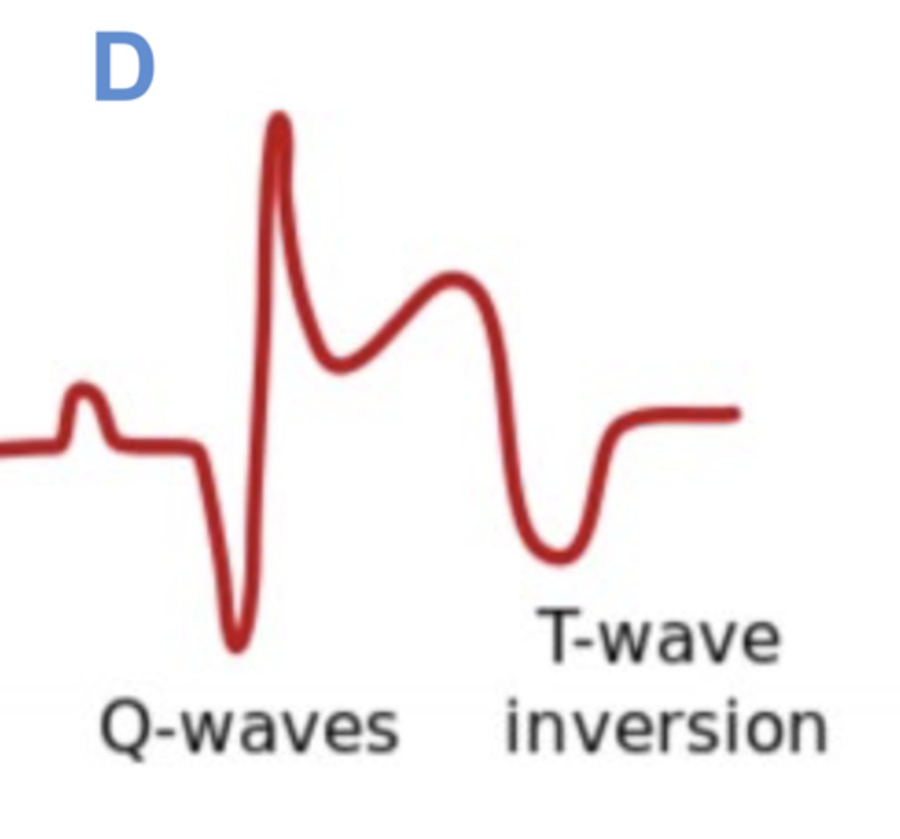 <p>ischemia or necrosis</p>