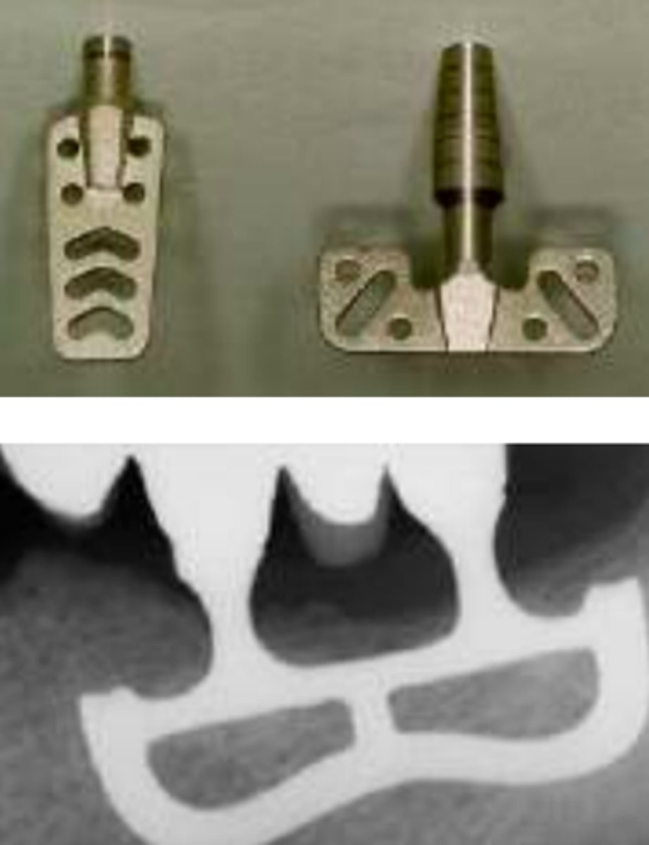 <p>ID the type of dental implant:</p>