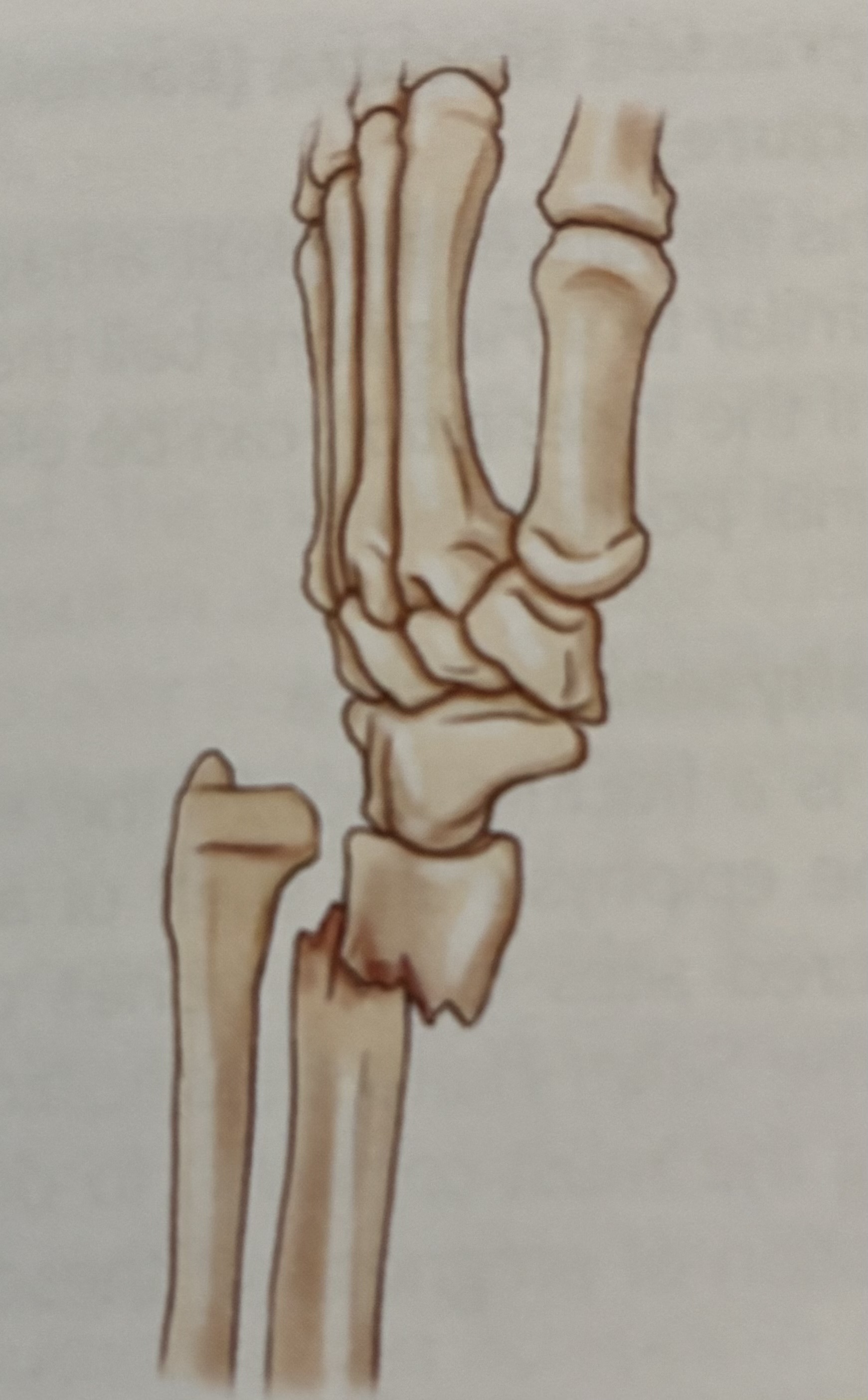 <p>What type of fracture is this?</p>