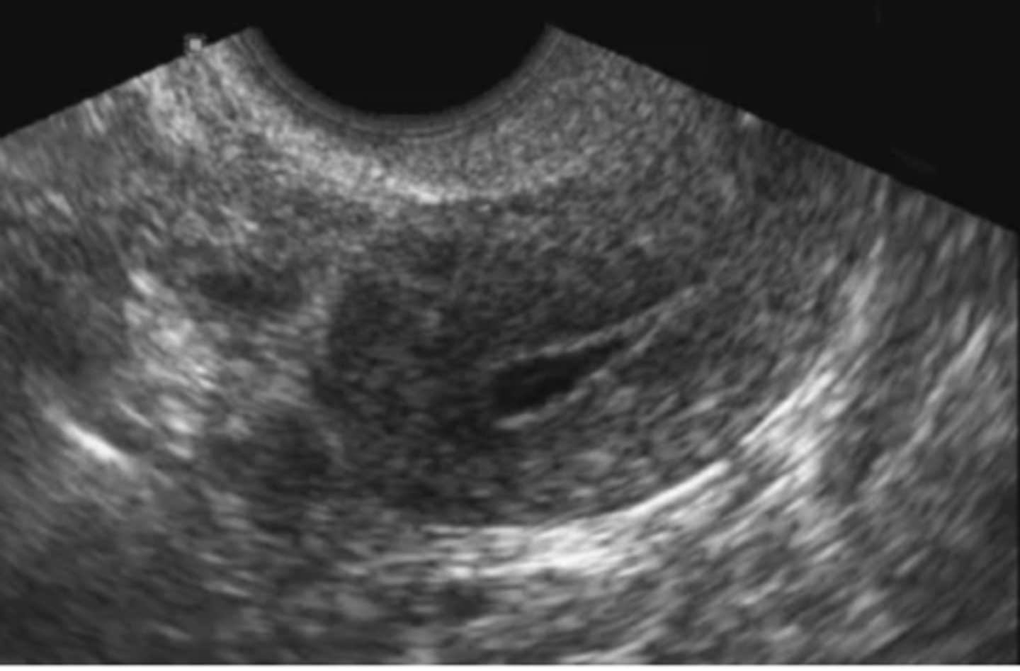<p>Measure anterior and posterior endometrial stripes separately and add the values together</p><p>-When fluid is present, it should be included in the measurement. Each side of the endo should be measured separately and then added together</p>
