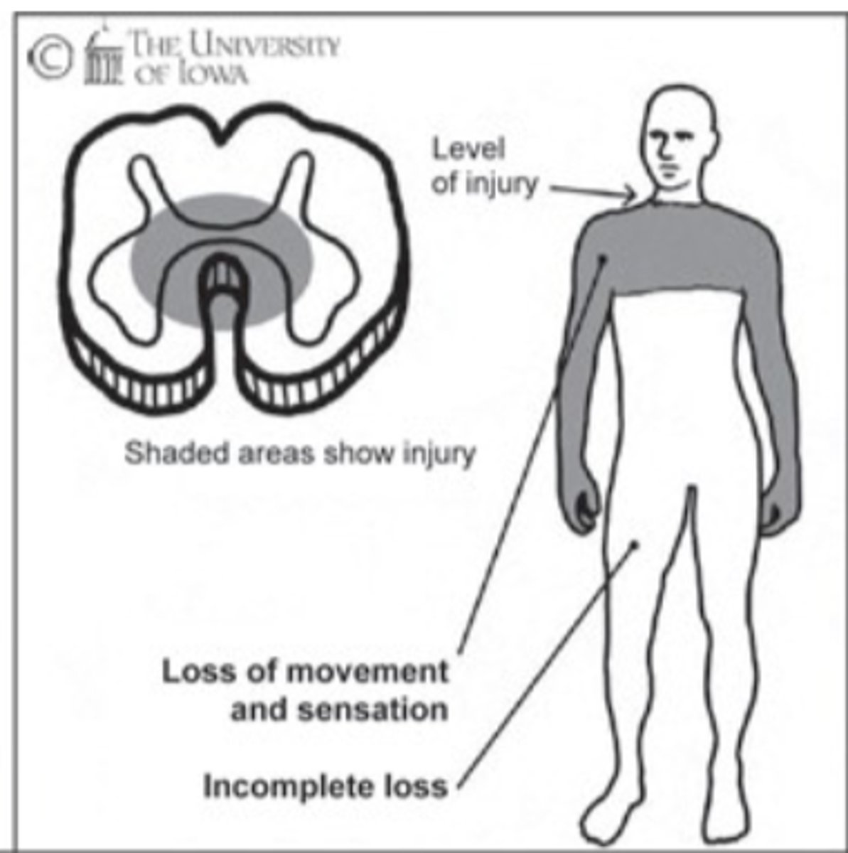 <p>This image depicts the damage associated with which Incomplete SCI Syndrome?</p>