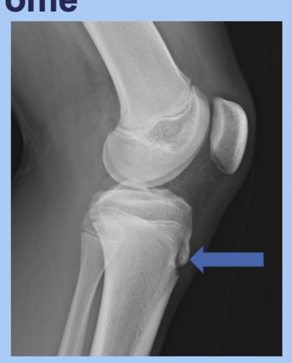 <p>-tibial tuberosity apophysitis (inflammation of tibial plate)</p><p>-common in active adolescents </p><p>-repetitive stress activities</p><p>-sx: knee pain with activity, improves with rest, palpable tibial tuberosity </p><p>-dx: XR may show fragmentation </p><p>-tx: rest, activity modification </p>