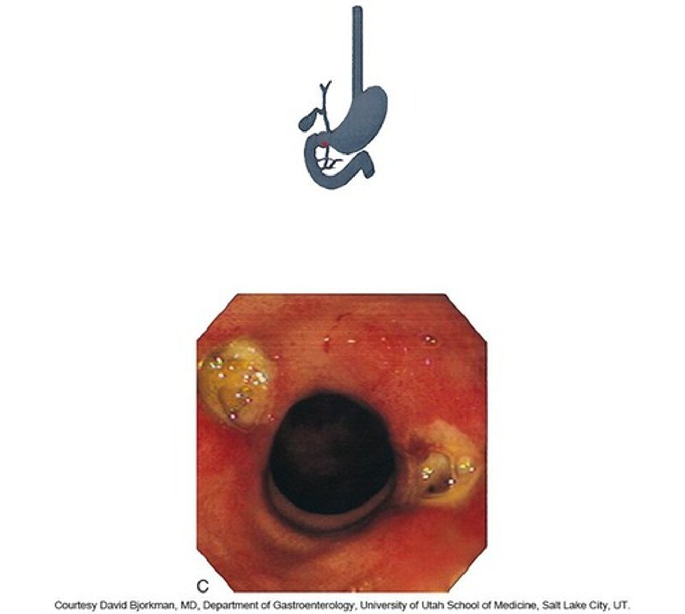 <p>Bloody vomit.</p>