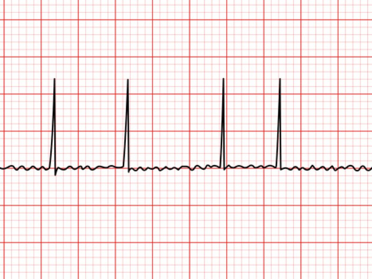 <p>an irregular and often very rapid heart rhythm<span>.</span></p>