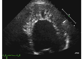 <p>This image is an example of:</p><p></p><p>Dilated Cardiomyopathy</p><p></p><p>Restrictive cardiomyopathy</p><p>&nbsp;</p><p>Noncompaction cardiomyopathy</p><p>&nbsp;</p><p>Hypertrophic cardiomyopathy</p><p>&nbsp;</p>