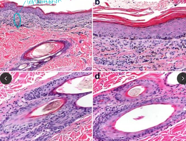 <p>Pemphigus Erythematosus (PE)</p>