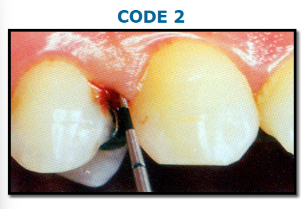 <p>colored area of probe completely visible, supra/ subgingival calculus or defective margins detected</p>