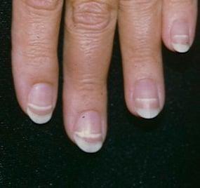 <p>results from slowed or halted nail growth in response to illness, physical trauma, or poisoning </p>