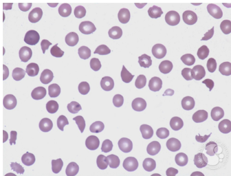 <p>what disease/condition is associated with schistocytes?</p>