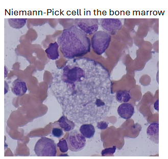 <p><span><span>leukopenia and thrombocytopenia may occur</span></span></p>