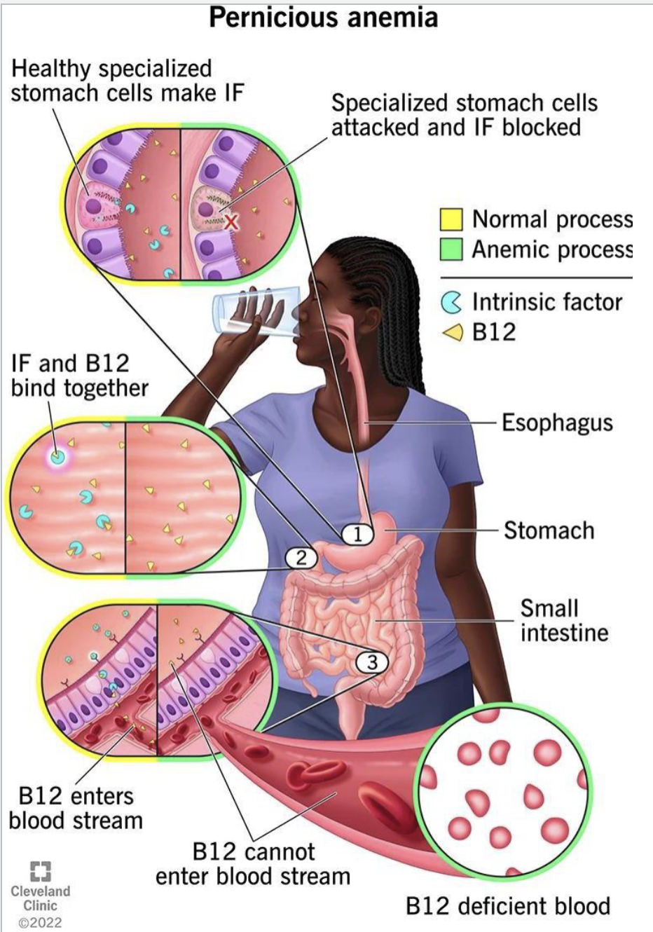 <p>Megaloblastic macrocytic anemia(lack of O<sub>2</sub>) </p><p>Pernicious anemia (autoimmume disease where antibodies destory intrinsic factors</p>