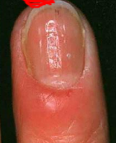 <p>an infection of the skin around the nails. </p>