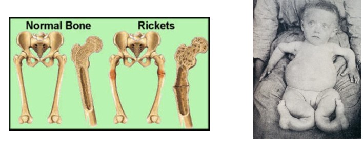 <p>impaired Ca2+ absorption</p><ul><li><p>PTH maintains plasma Ca2+ at expense of bones</p><ul><li><p>Softened bones deform</p></li><li><p>Rickets (in children)</p></li><li><p>Osteomalacia (in adults)</p></li></ul></li></ul>