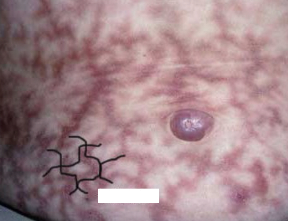 <p>what shape/arrangement and condition is depicted</p>