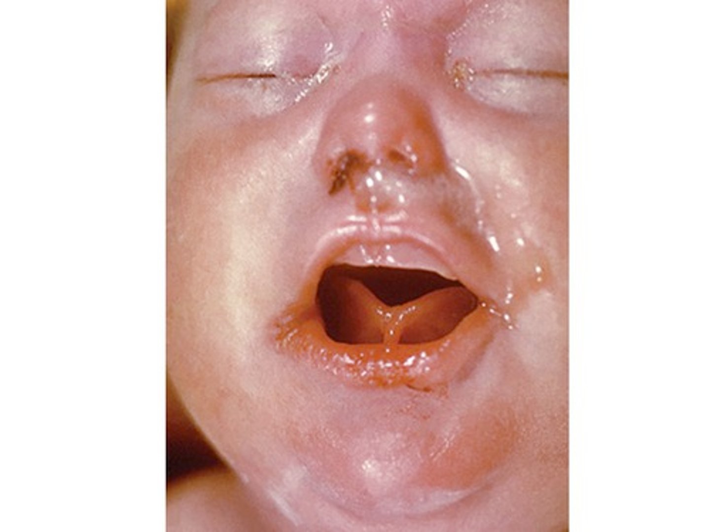 <p>-presents in first two years of life with snuffles, rash, skeletal abnormalities, IUGR</p>