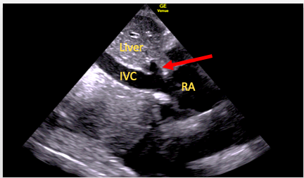 <ul><li><p>IVC/hepatic vein</p></li><li><p>RA</p></li><li><p>TV</p></li></ul><p></p>