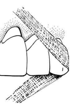 <p>Non-traditional interdental aids </p>