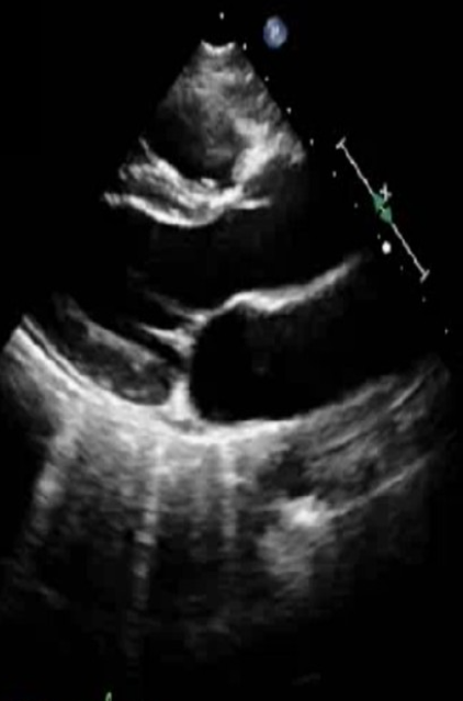 <p>First image taken with an increased depth to visualize effusion </p>