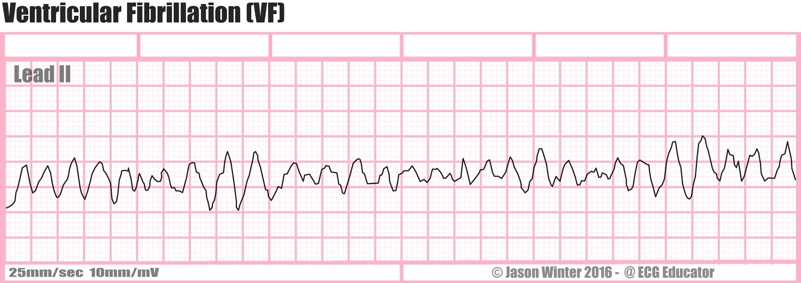 <p>Ventricular fibrillation</p>