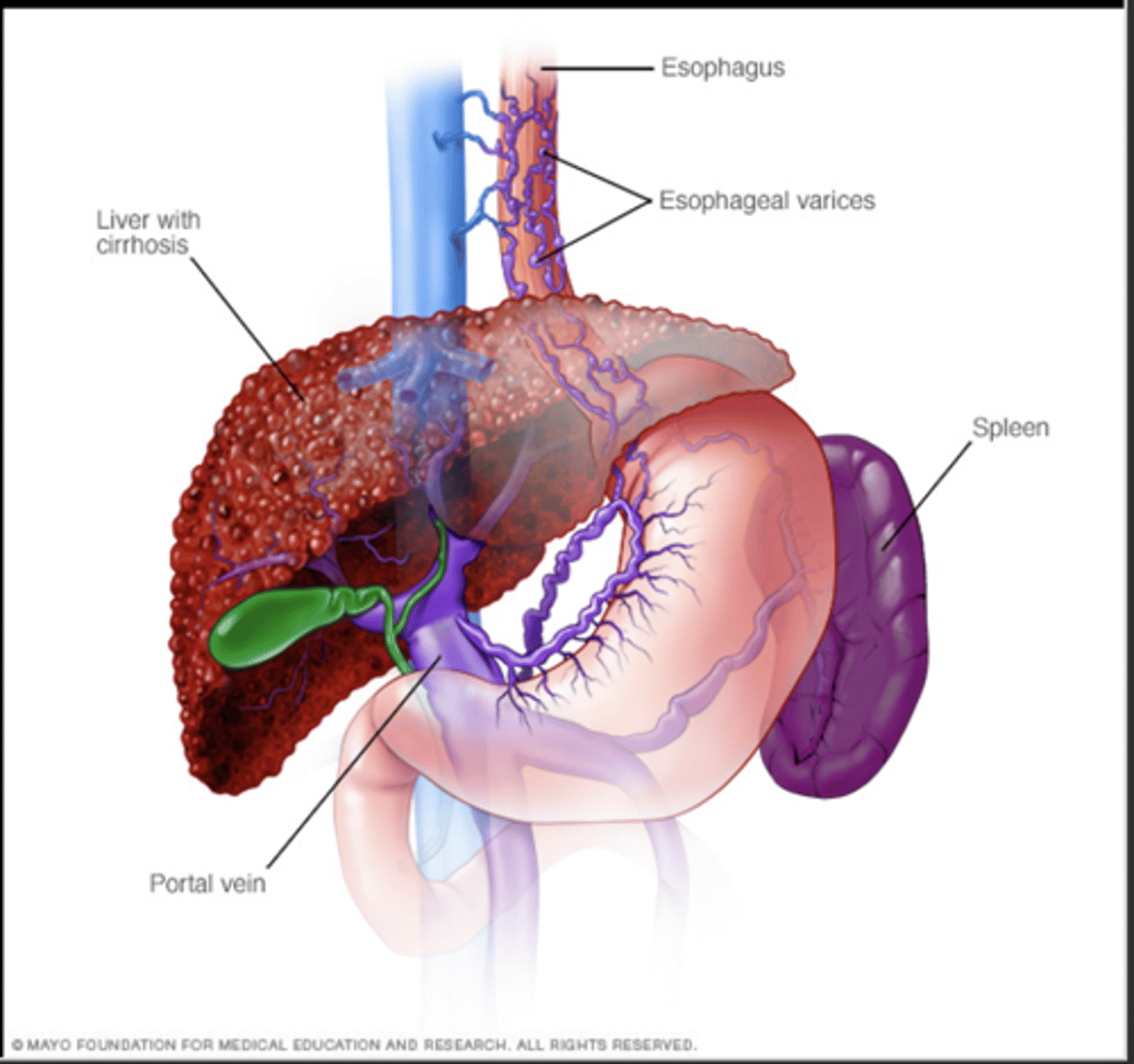 <p>Abnormal high blood pressure in the portal venous system due to resistance to portal blood flow</p><p>–Causes</p><p>- Liver damage</p><p>- Liver disease (main cirrhosis)</p><p>Consequences</p><p>- Varices</p><p>- Lower esophagus, stomach, rectum</p><p>- Splenomegaly</p><p>- Ascites</p><p>-Hepatic encephalopathy</p><p>Treatment</p><p>- Preventing or managing the complications</p>