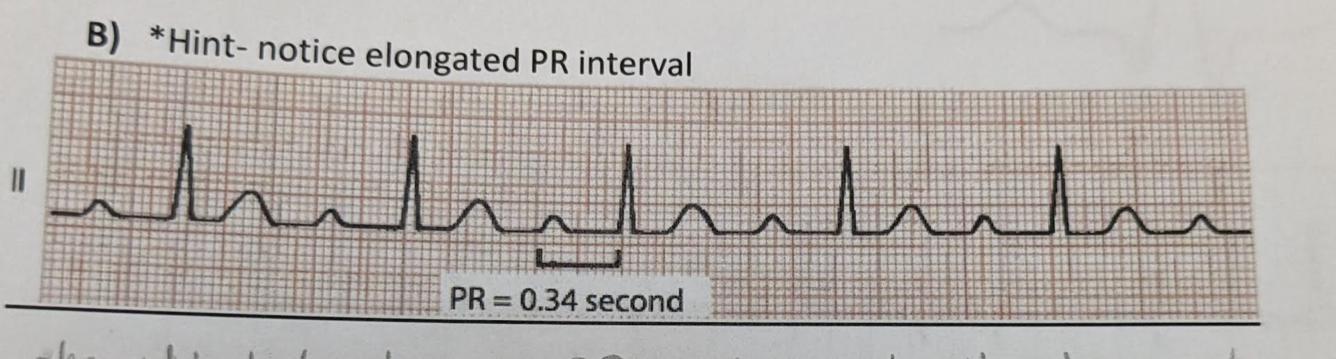 <p>identify the ECG abnormalities (if any)</p>