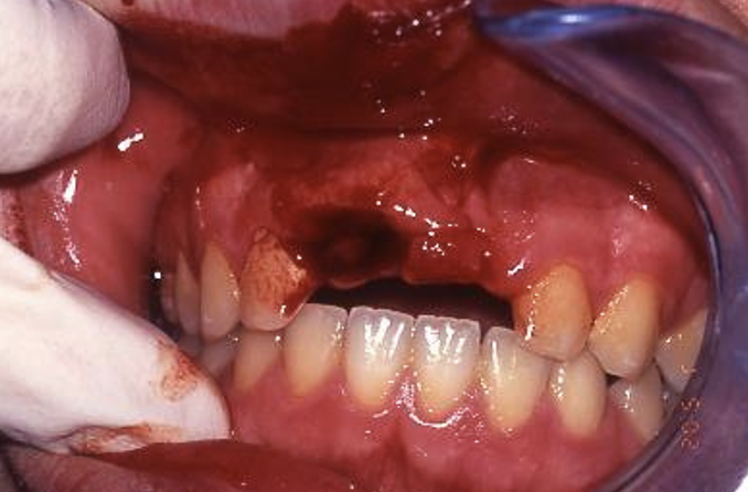 <p>which periodontal tissue injury does this image show</p>