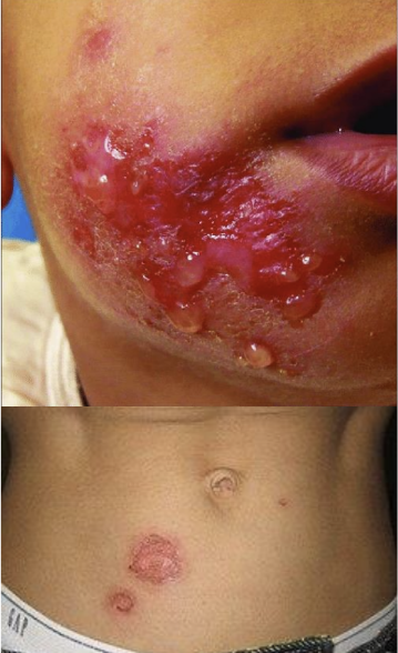 <p><span><span>Staphylococcus aureus infection</span></span></p><p>Bullous impetigo; Impetigo is a superficial bacterial infection that causes the skin to flake or peel large; a fluid-filled blisters caused by exfoliative toxin A. Common in newborns.</p>