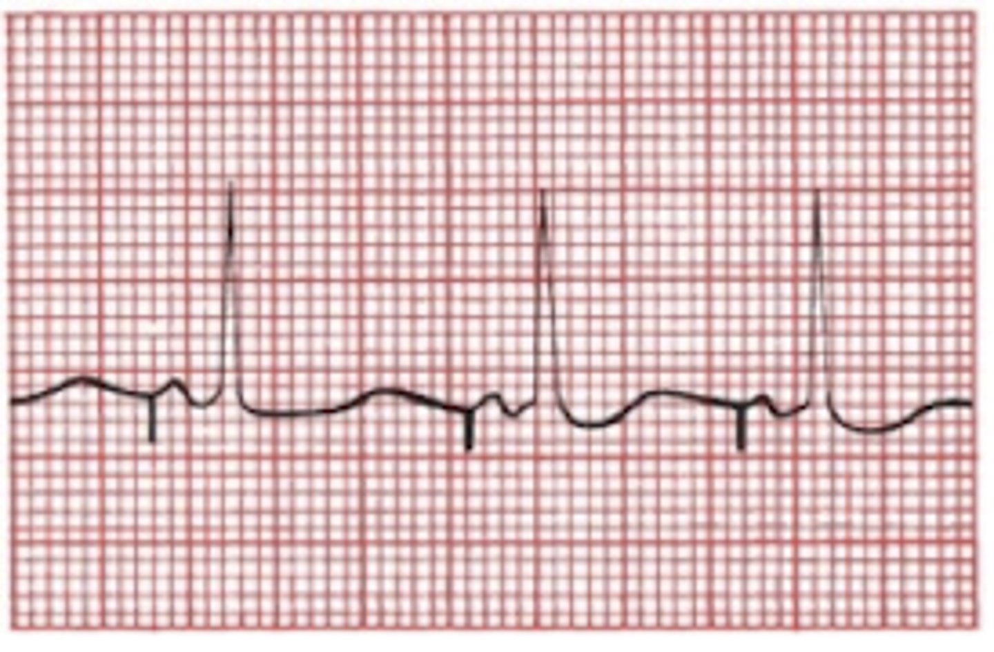 <p>-spike followed by a P wave, normal PRI, normal QRS</p>