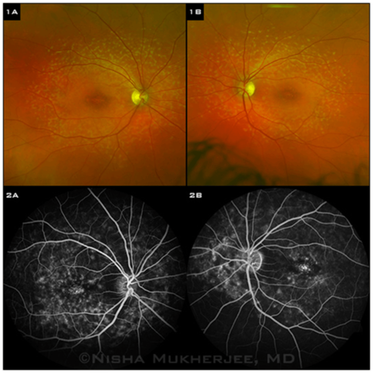 <p>dark choroid due to extreme accumulation of lipofuscin in the RPE that blocks underlying choroid</p><p>hyperfluorescent flecks that stain</p>