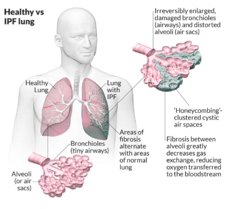 <ul><li><p>air sacs in thin membrane allows gas exchange </p></li><li><p>IPF is fibrosis of the alveoli, prevents gas exchange, can’t get rid of CO2 </p></li><li><p>affects 14-43 per 100,000 people </p></li><li><p>seen more commonly in men </p></li><li><p>common symptoms -</p><ul><li><p>shortness of breath</p></li><li><p>chronic, dry cough </p></li><li><p>finger clubbing due to growth factor signalling </p></li></ul></li><li><p>occasional symptoms </p><ul><li><p>fatigue</p></li><li><p>weakness</p></li><li><p>weight loss </p></li></ul></li><li><p>cause is unknown but risk factors- smoking, environmental exposure, chronic viral infections, abnormal acid reflux, family history of the disease</p></li><li><p>average time to diagnosis is 1-2 years after onset of sytmptoms</p></li><li><p>50% die within 2-3 years after diagnossi </p></li><li><p>aging is a risk factor </p></li></ul><p></p>