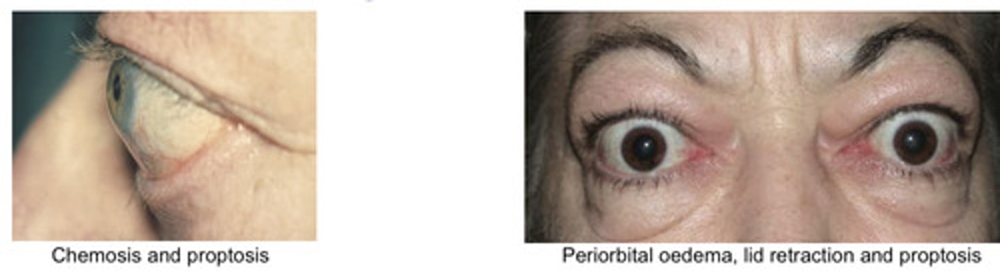 <p>Oedema (periorbital and chemosis)</p><p>Proptosis (best assessed from the side)</p><p>Retraction (autonomically mediated)</p><p>Exposure keratopathy</p><p>Ophthalmoplegia (upgaze palsy)</p>