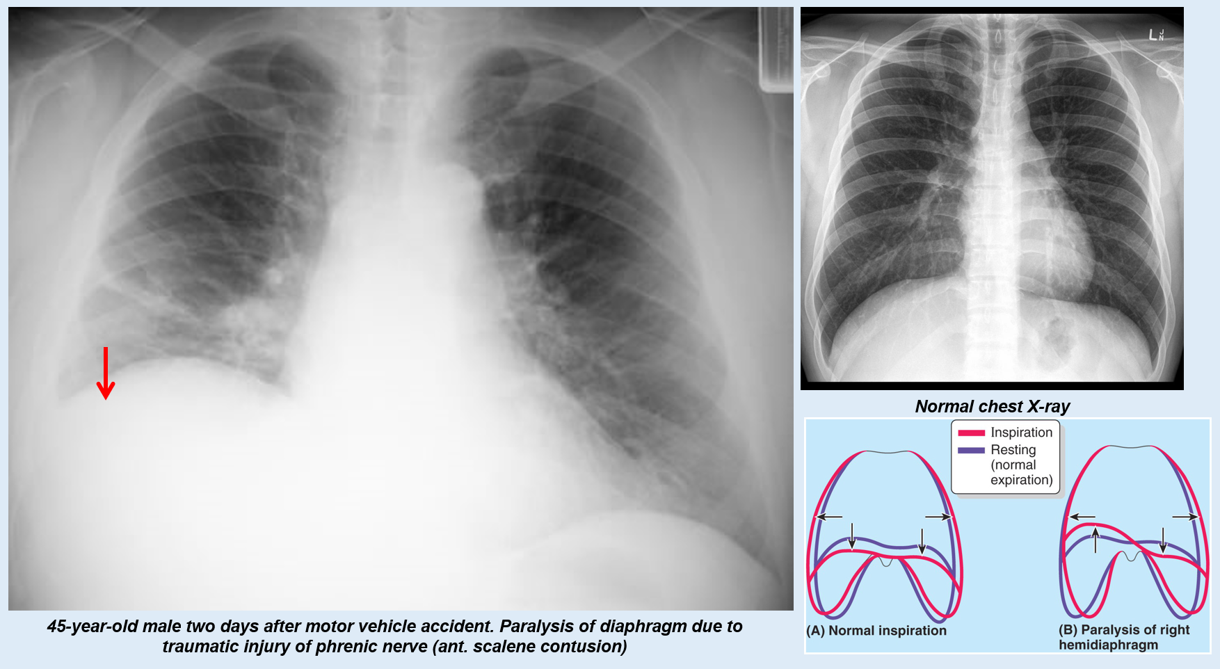 <p>One side of the diaphragm would not work. Asymmetry</p>